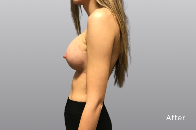 Breast-Augmentation