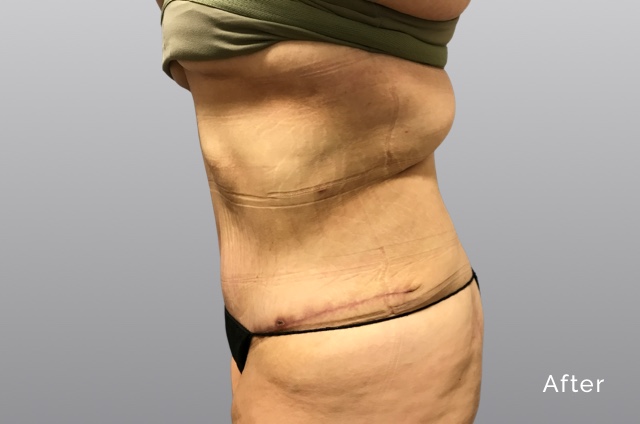 Tummy Tuck w-Liposuction