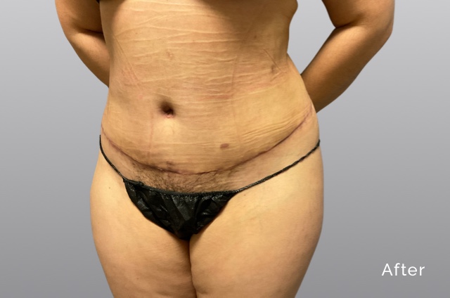 Tummy Tuck w-Liposuction