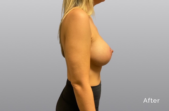 Breast Augmentation and LiftKCa3