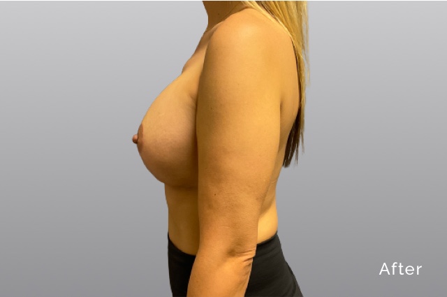 Breast Augmentation and LiftKCa5