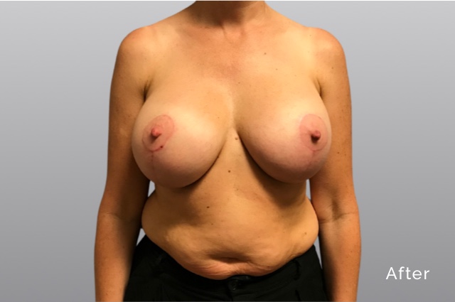 Breast Augmentation and LiftKRa1