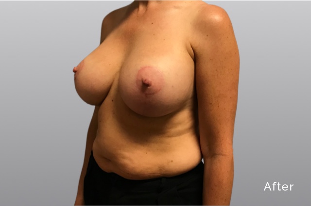 Breast Augmentation and LiftKRa2