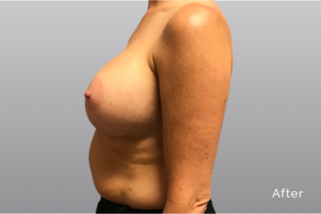 Breast Augmentation and LiftKRa4.jpg