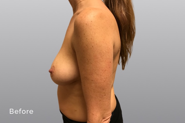 Breast Augmentation and LiftKRb4
