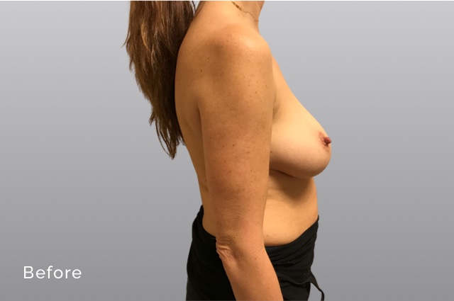 Breast Augmentation and LiftKRb5