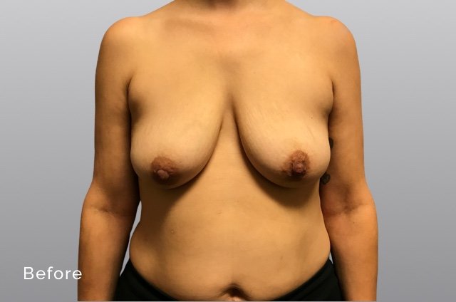 Breast Augmentation and LiftSVb1.jpg