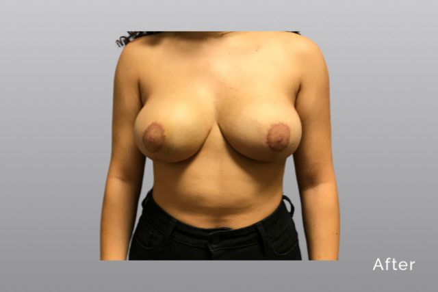 Breast-ReductionAGa1.jpg