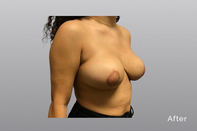 Breast-ReductionAGa3.jpg