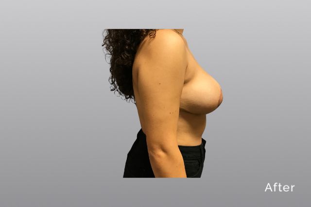 Breast-ReductionAGa4.jpg