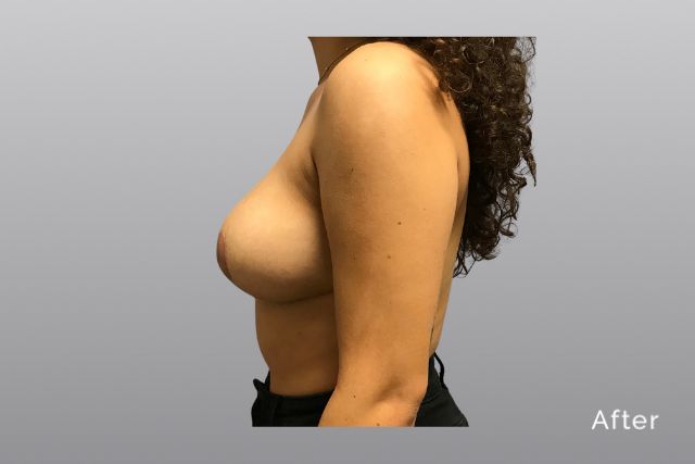 Breast-ReductionAGa5.jpg