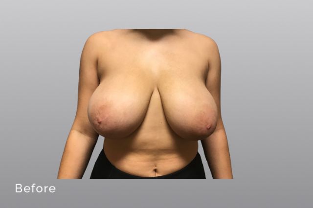 Breast-ReductionAGb1.jpg