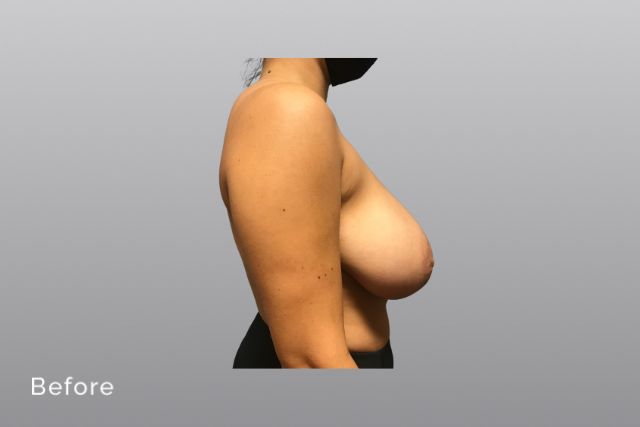 Breast-ReductionAGb4.jpg