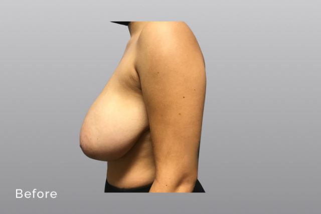 Breast-ReductionAGb5.jpg