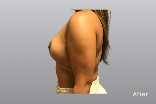 Breast-ReductionCCa2.jpg