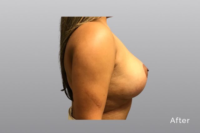 Breast-ReductionCCa3.jpg