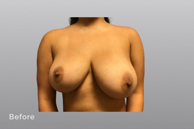 Breast-ReductionCCb1.jpg