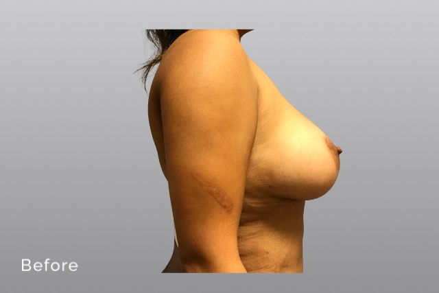 Breast-ReductionCCb3.jpg