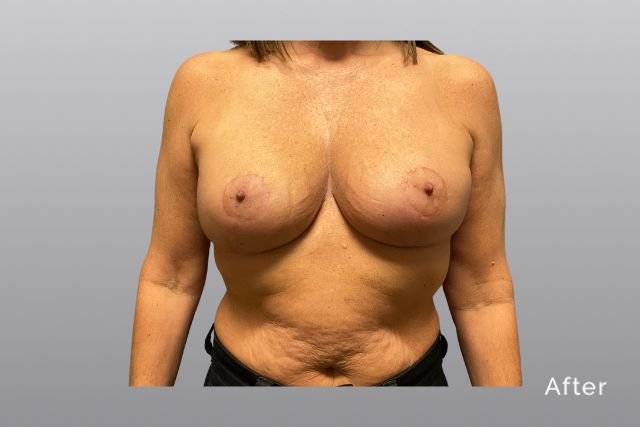 Breast-ReductionHRa1.jpg