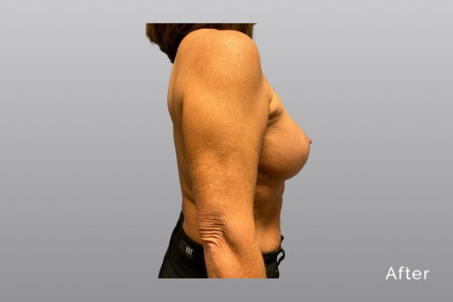 Breast-ReductionHRa2.jpg