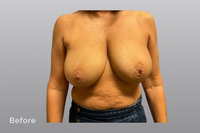 Breast-ReductionHRb1.jpg