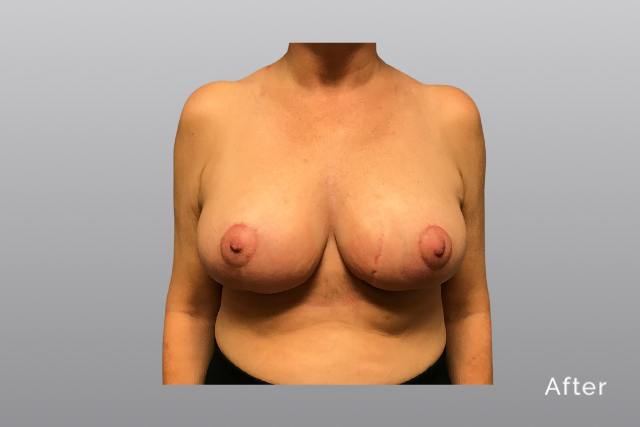 breastreductionMHa1.jpg