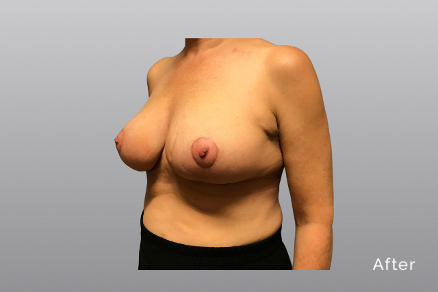 breastreductionMHa2.jpg