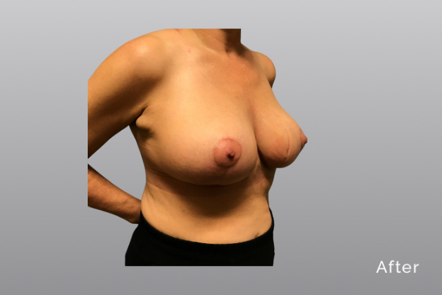 breastreductionMHa3.jpg