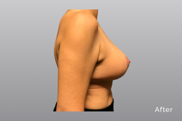 breastreductionMHa4.jpg