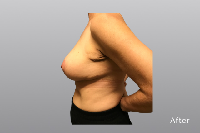 breastreductionMHa5.jpg