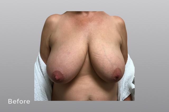 breastreductionMHb1.jpg
