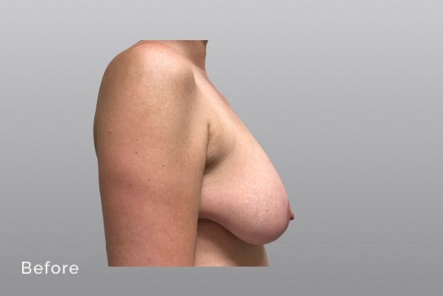 breastreductionMHb4.jpg